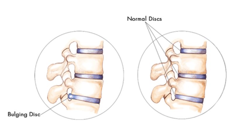 Herniated or Bulging Disc