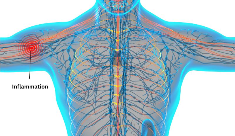 Neuropathy and nerve Inflammation